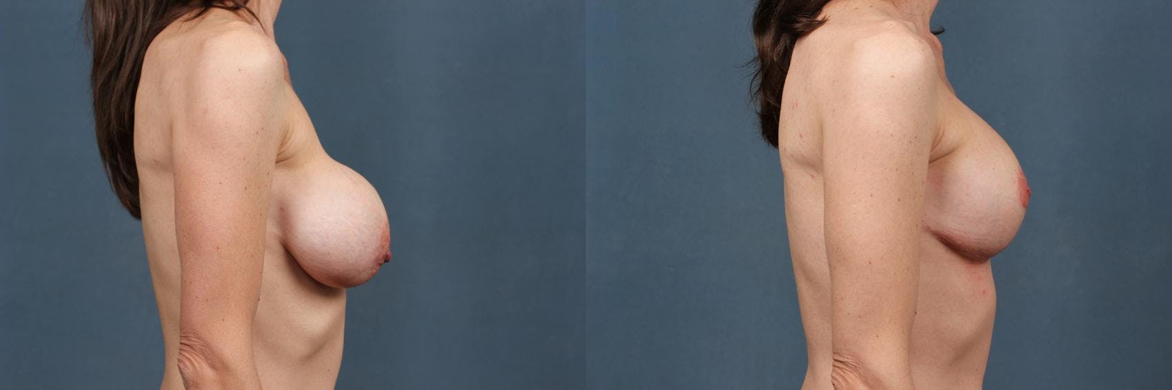 Revision Before & After Gallery - Patient 326441 - Image 3