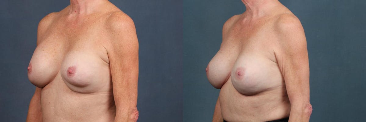 Revision Before & After Gallery - Patient 180508 - Image 2