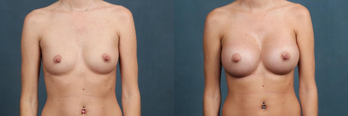 Revision Before & After Gallery - Patient 237257 - Image 1