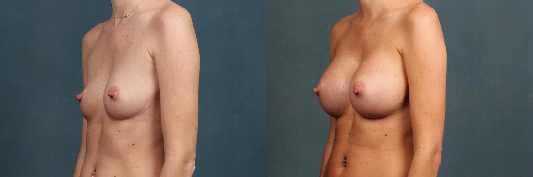 Revision Before & After Gallery - Patient 237257 - Image 2