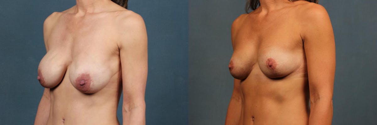 Revision Before & After Gallery - Patient 199621 - Image 2