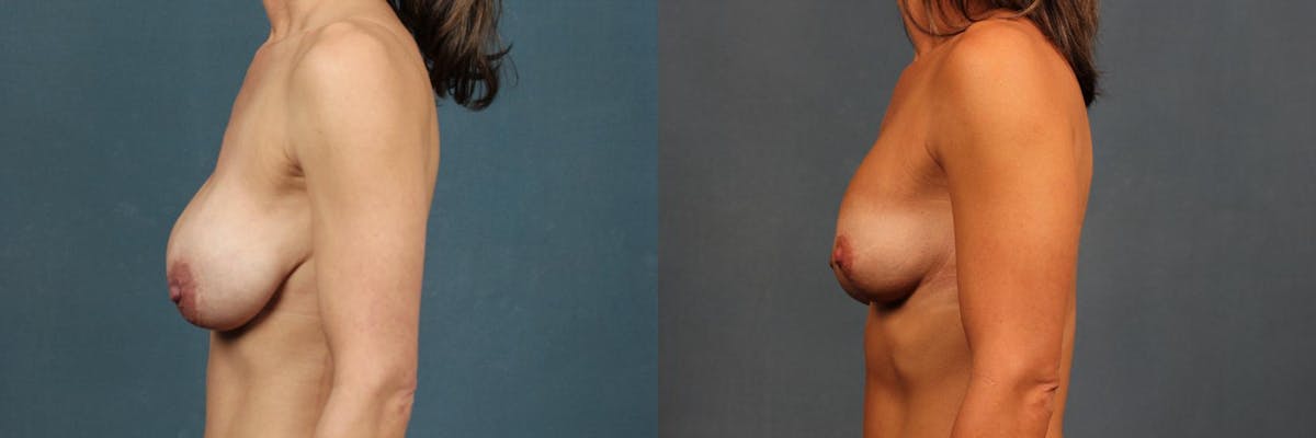 Revision Before & After Gallery - Patient 199621 - Image 3