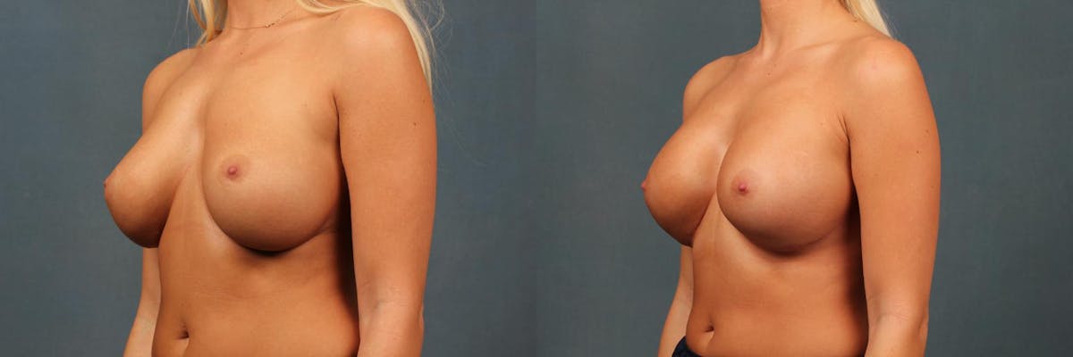 Revision Before & After Gallery - Patient 208826 - Image 2