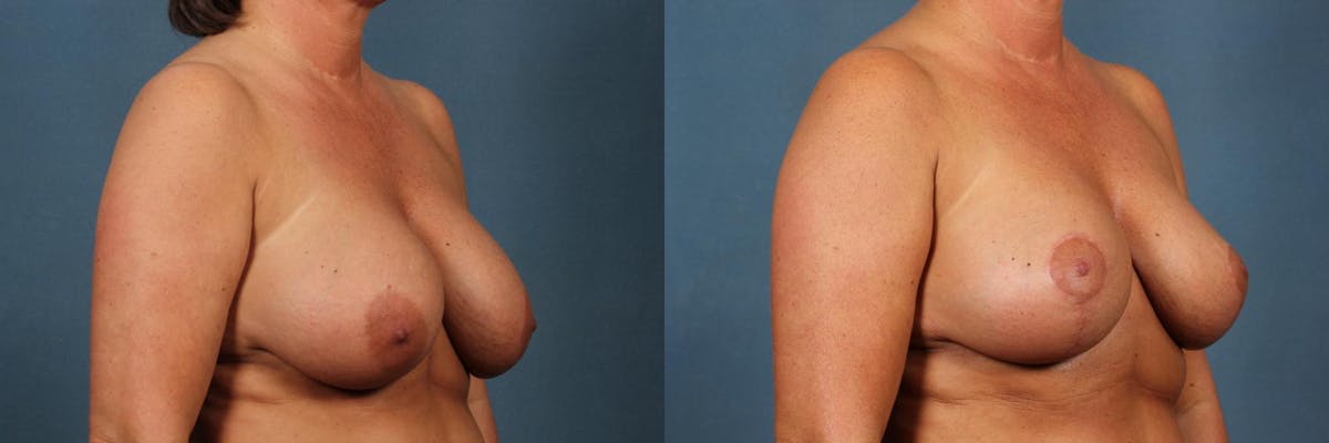 Revision Before & After Gallery - Patient 260919 - Image 2