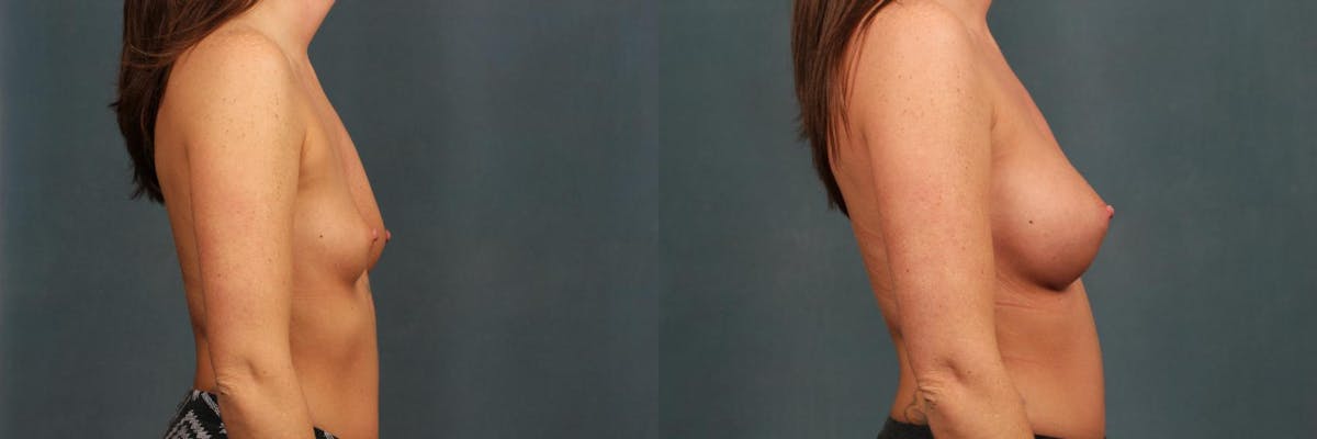 Revision Before & After Gallery - Patient 308921 - Image 3