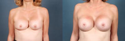 Revision Before & After Gallery - Patient 347369 - Image 1