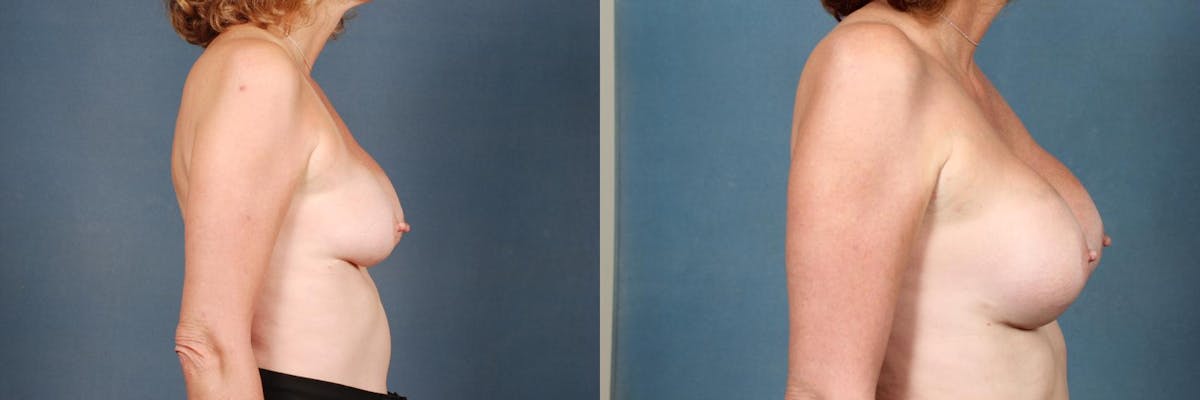 Revision Before & After Gallery - Patient 347369 - Image 2