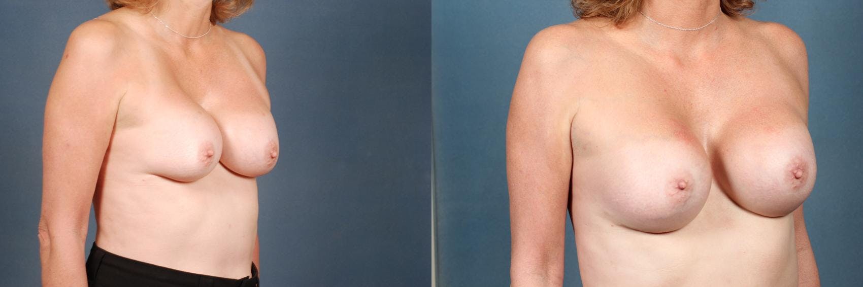 Revision Before & After Gallery - Patient 347369 - Image 3