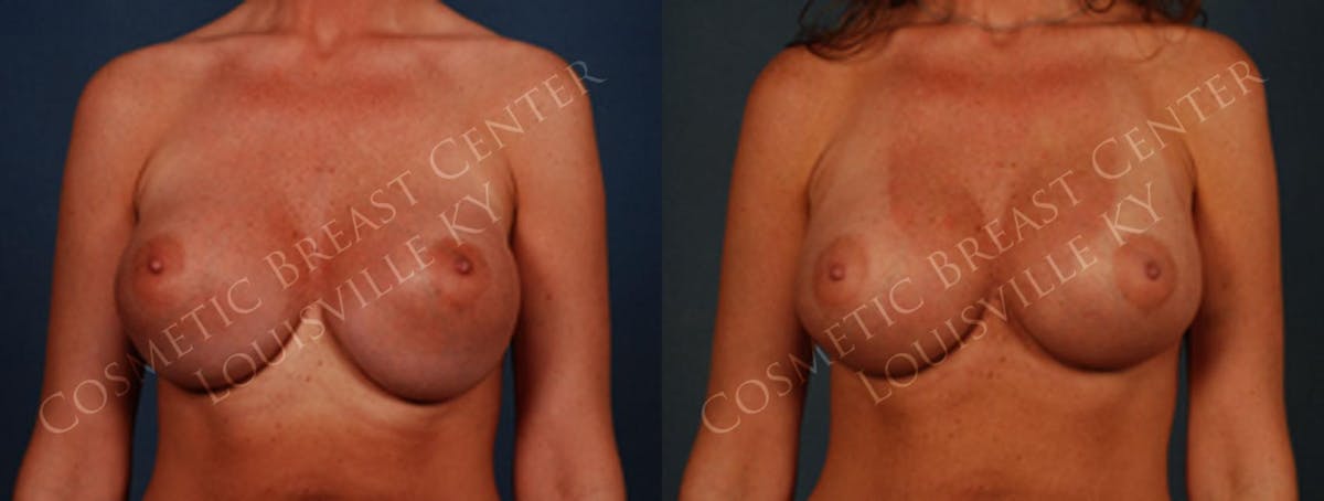 Revision Before & After Gallery - Patient 464602 - Image 1