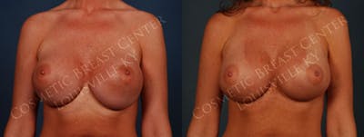 Revision Before & After Gallery - Patient 464602 - Image 1
