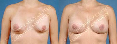 Revision Before & After Gallery - Patient 392253 - Image 1