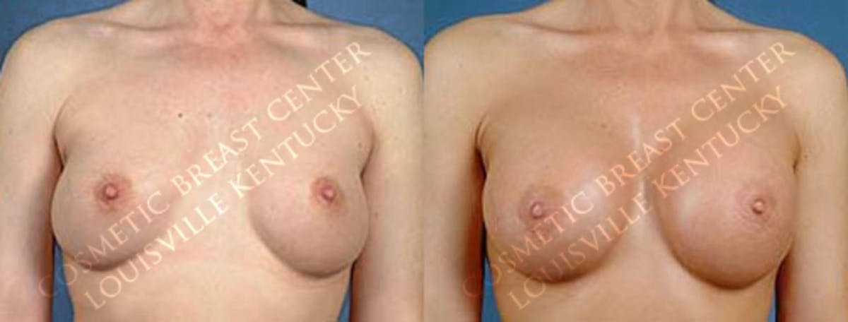 Revision Before & After Gallery - Patient 407841 - Image 1