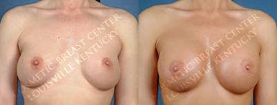 Revision Before & After Gallery - Patient 407841 - Image 1