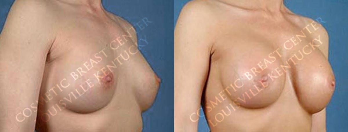 Revision Before & After Gallery - Patient 407841 - Image 2