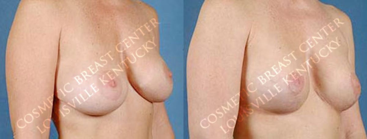 Revision Before & After Gallery - Patient 509195 - Image 2
