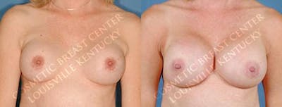 Revision Before & After Gallery - Patient 368832 - Image 1