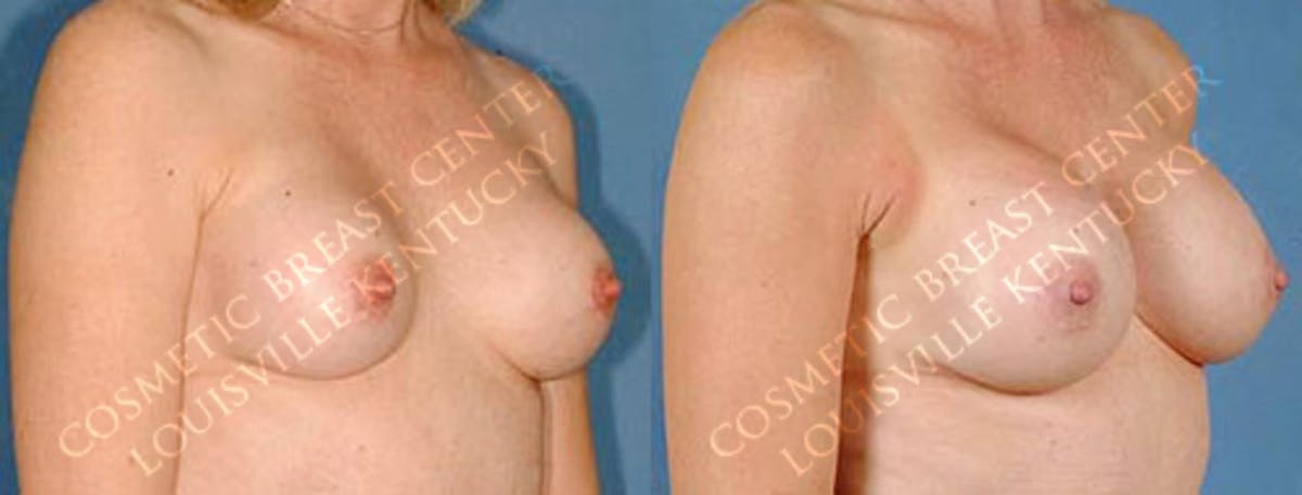 Revision Before & After Gallery - Patient 368832 - Image 2