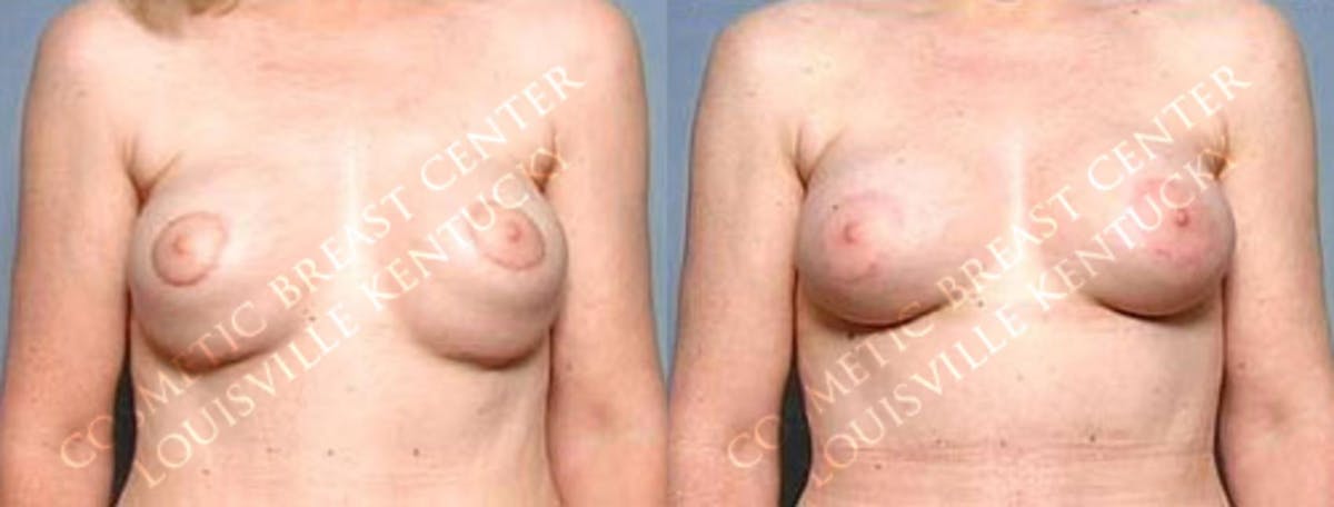 Revision Before & After Gallery - Patient 357755 - Image 1