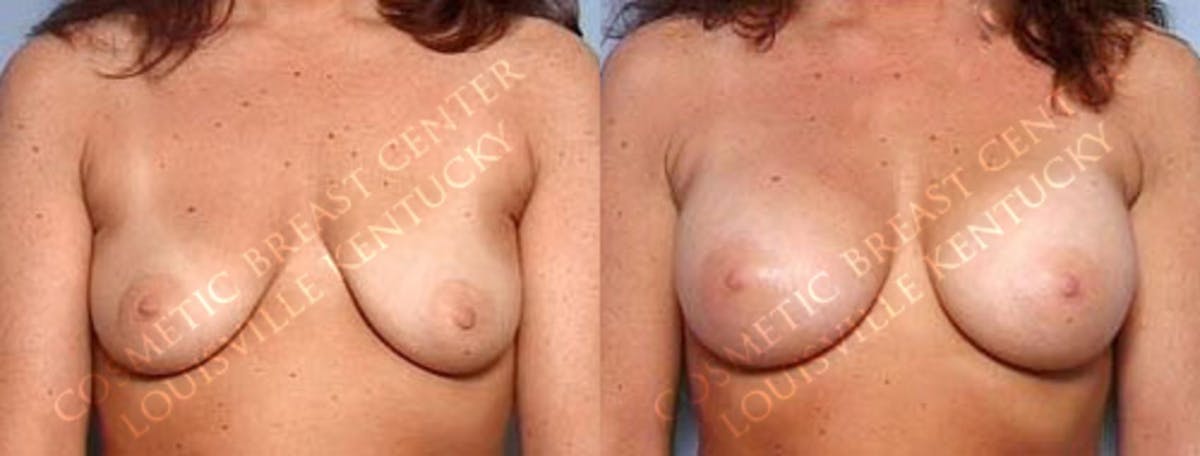 Enlargement - Saline Before & After Gallery - Patient 391091 - Image 1