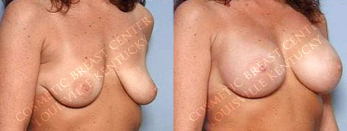 Enlargement - Saline Before & After Gallery - Patient 391091 - Image 2