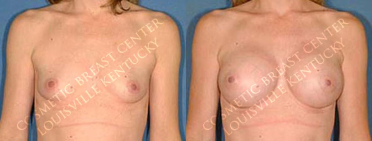 Enlargement - Saline Before & After Gallery - Patient 211276 - Image 1