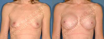 Enlargement - Saline Before & After Gallery - Patient 211276 - Image 1