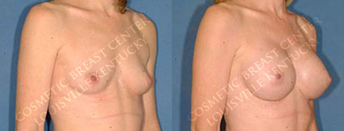 Enlargement - Saline Before & After Gallery - Patient 211276 - Image 2