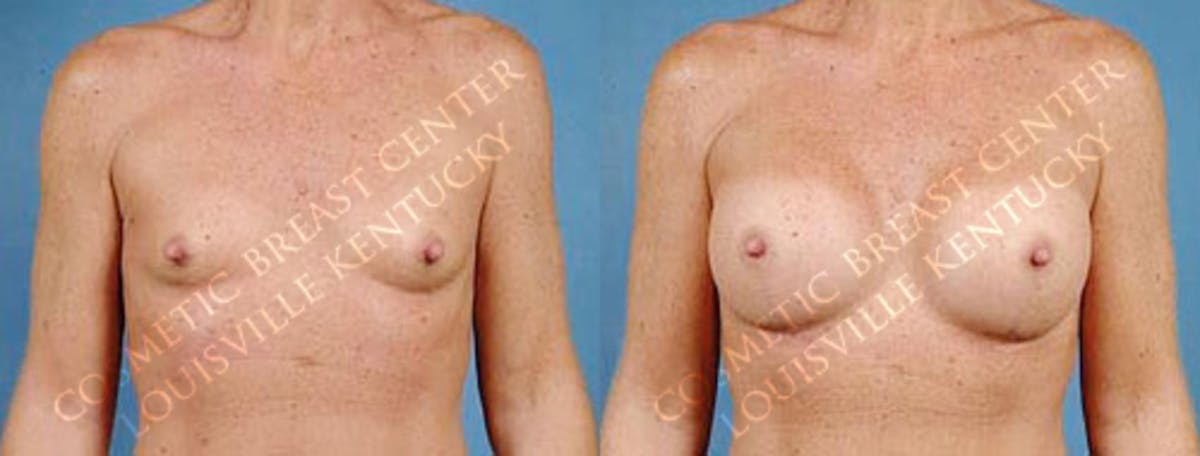 Enlargement - Saline Before & After Gallery - Patient 380284 - Image 1