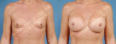 Enlargement - Saline Before & After Gallery - Patient 380284 - Image 1