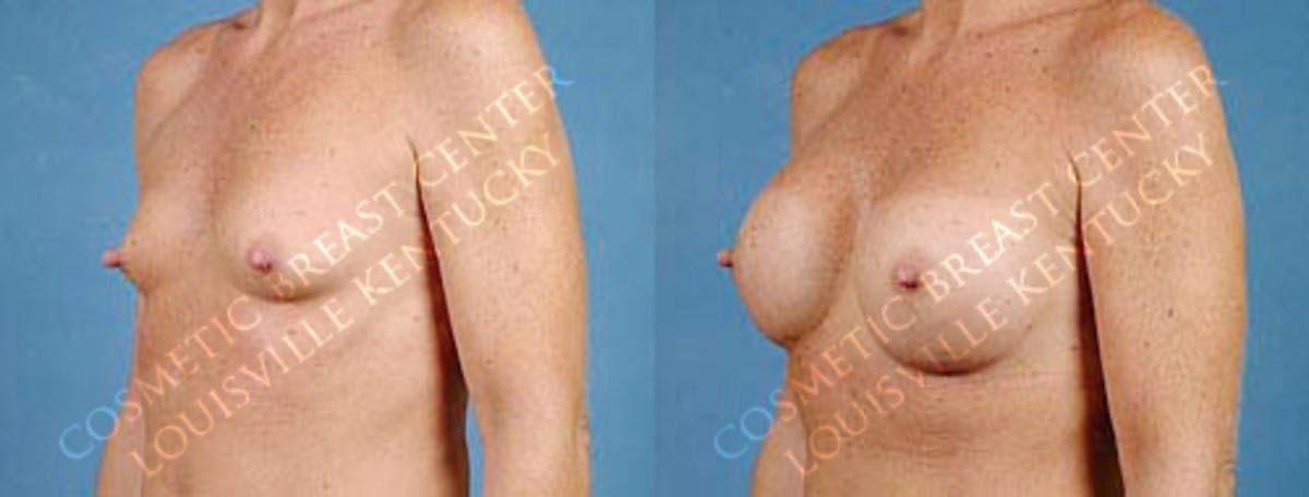 Enlargement - Saline Before & After Gallery - Patient 380284 - Image 2