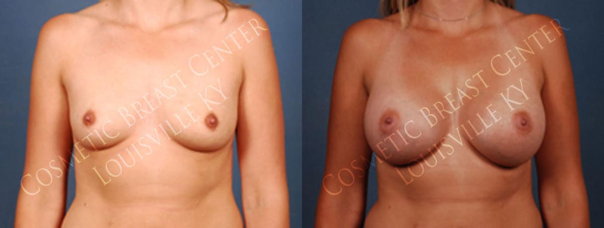 Enlargement - Saline Before & After Gallery - Patient 377537 - Image 1