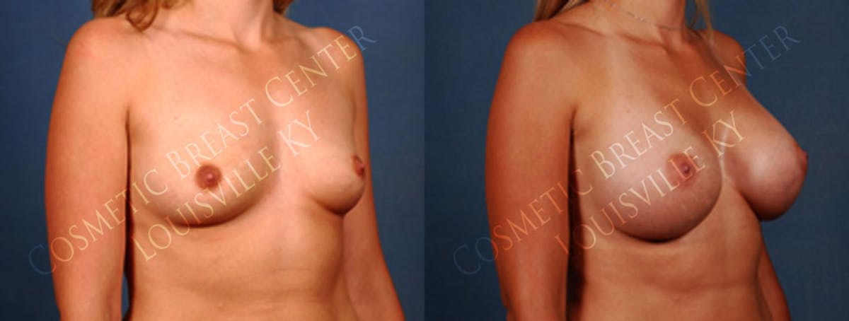 Enlargement - Saline Before & After Gallery - Patient 377537 - Image 2