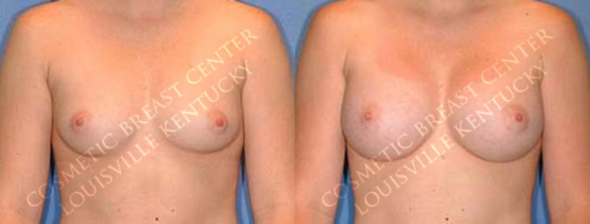 Enlargement - Saline Before & After Gallery - Patient 524177 - Image 1