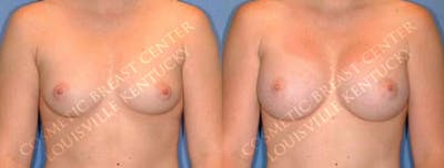 Enlargement - Saline Before & After Gallery - Patient 524177 - Image 1