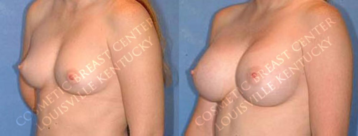 Enlargement - Saline Before & After Gallery - Patient 524177 - Image 2