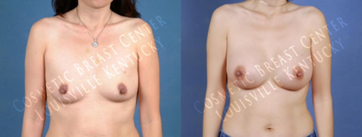 Enlargement - Saline Before & After Gallery - Patient 371726 - Image 1