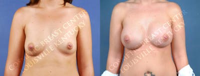 Enlargement - Saline Before & After Gallery - Patient 278986 - Image 1