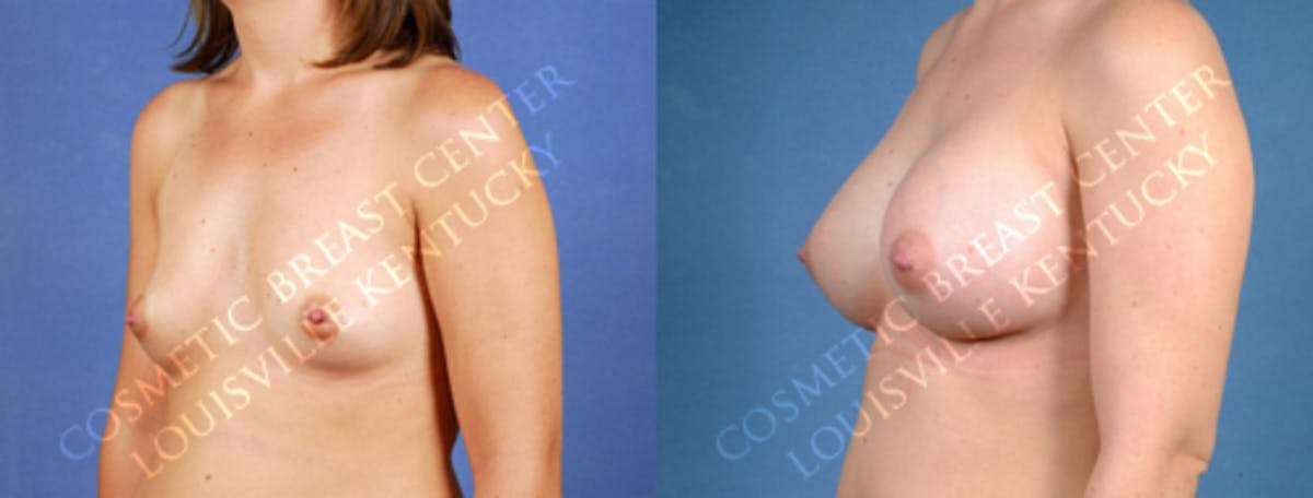 Enlargement - Saline Before & After Gallery - Patient 278986 - Image 2