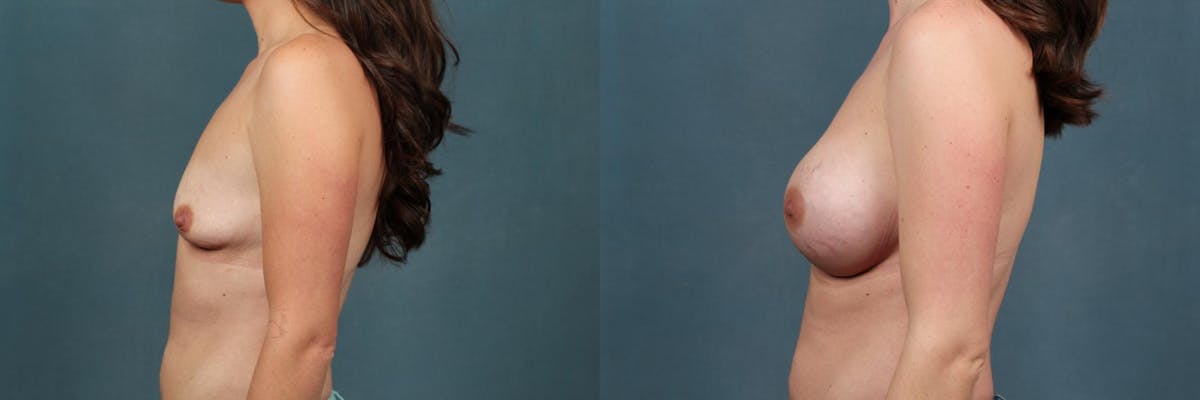 Enlargement - Silicone Before & After Gallery - Patient 418045 - Image 3