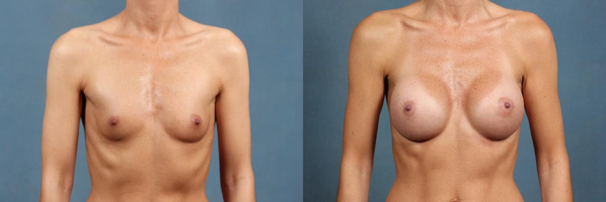 Enlargement - Silicone Before & After Gallery - Patient 352389 - Image 1