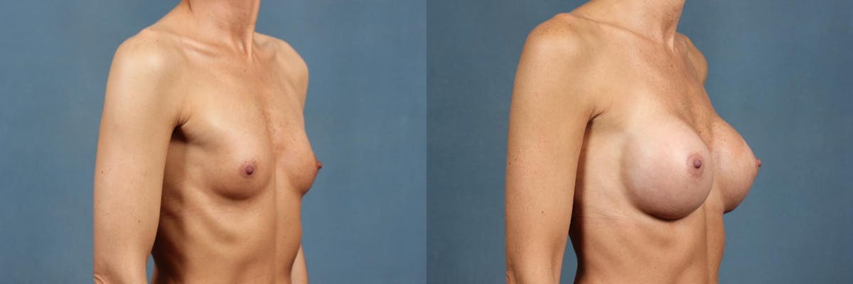Enlargement - Silicone Before & After Gallery - Patient 352389 - Image 2