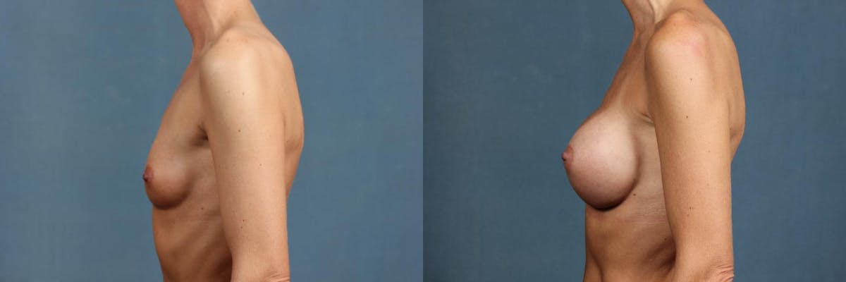 Enlargement - Silicone Before & After Gallery - Patient 352389 - Image 3