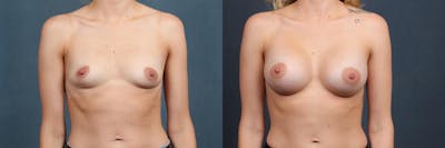 Enlargement - Silicone Before & After Gallery - Patient 320292 - Image 1