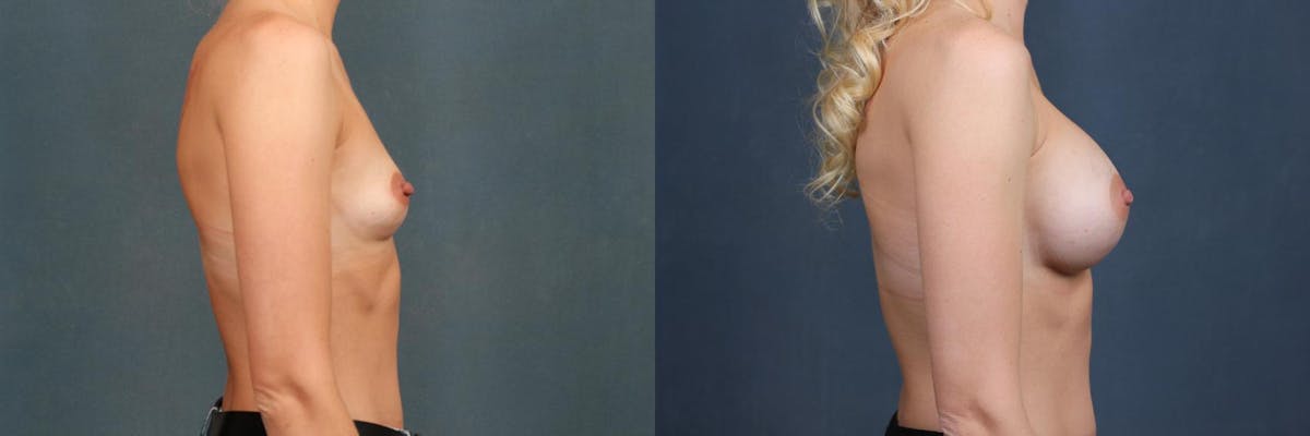 Enlargement - Silicone Before & After Gallery - Patient 320292 - Image 3