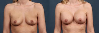 Enlargement - Silicone Before & After Gallery - Patient 317055 - Image 1