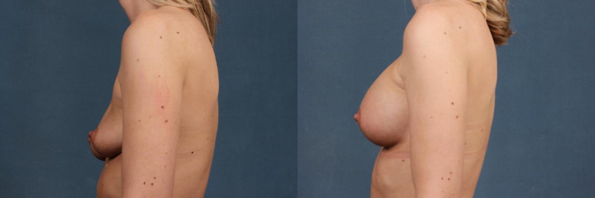 Enlargement - Silicone Before & After Gallery - Patient 317055 - Image 3