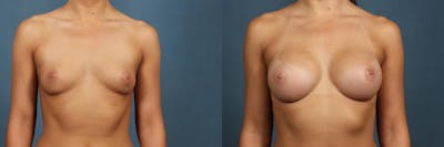 Enlargement - Silicone Before & After Gallery - Patient 304343 - Image 1