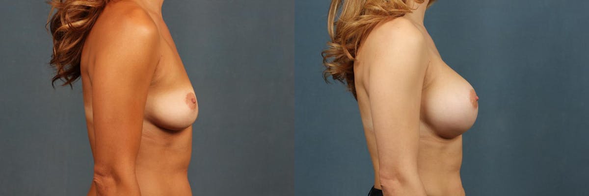 Enlargement - Silicone Before & After Gallery - Patient 286715 - Image 3