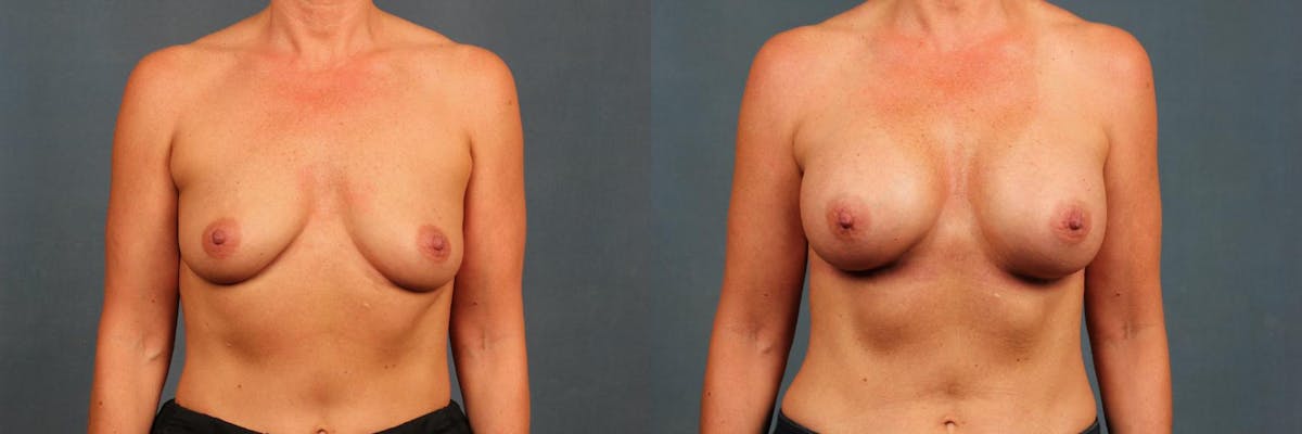 Enlargement - Silicone Before & After Gallery - Patient 263676 - Image 1