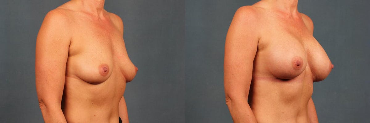 Enlargement - Silicone Before & After Gallery - Patient 263676 - Image 2